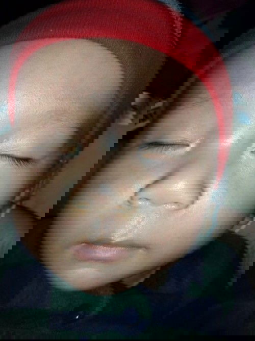 ผื่นส่าไข้