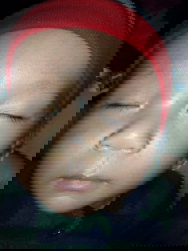 ผื่นส่าไข้