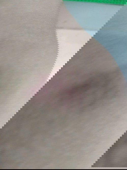 Hamil 29 minggu ruam di lutut