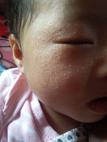 dry skin sa pisngi ni baby