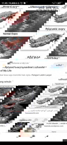 Sharing tentang PCOS dong bun