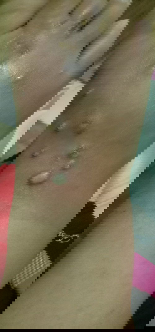 Kaki keluar bentol bentol berair