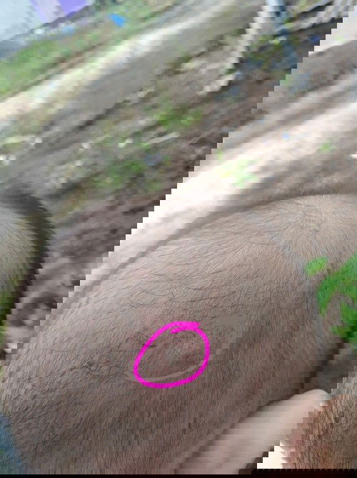 Kelenjar/benjolan ???