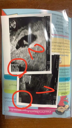 เด็กหยุดการเจริญเติบโต