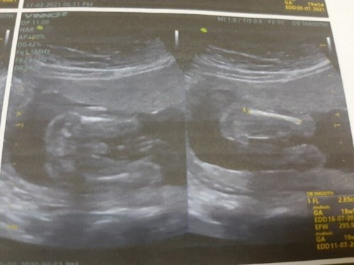วันนี้ไปซาวด์ดูเพศหนูน้อยมา ได้ลูกชายสมใจคุณพ่อเค้าล่ะ