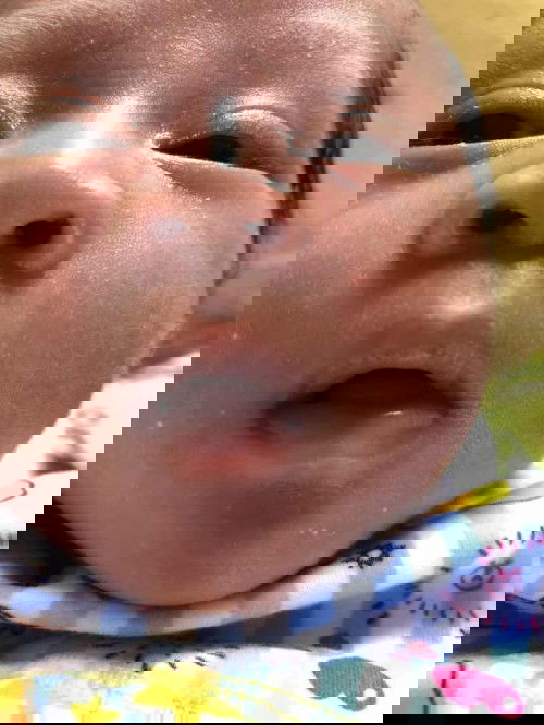 Apakah alergi sufor ?