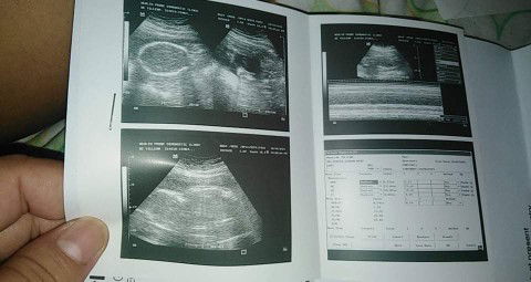 Sa tingin nyo po girl o boy