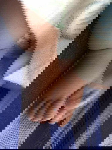 นิ้วเกินจากกรรมพันธุ์