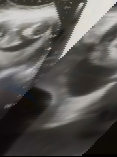 KISTA yang tidak diharapkan