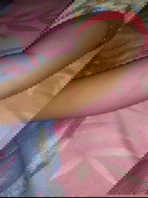 Bentol pada kulit bayi