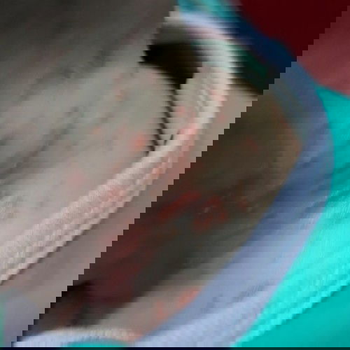 Ruam merah di leher bayi