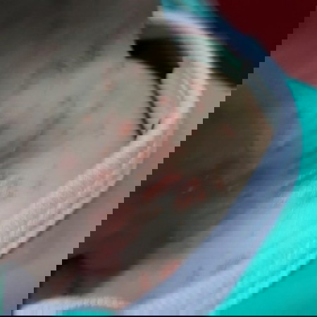 Ruam merah di leher bayi