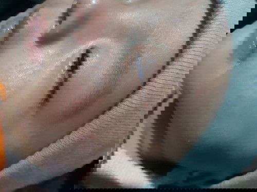 Ruam pipi & Kemerahan