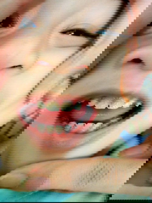 Usia 18 bulan gigi item2