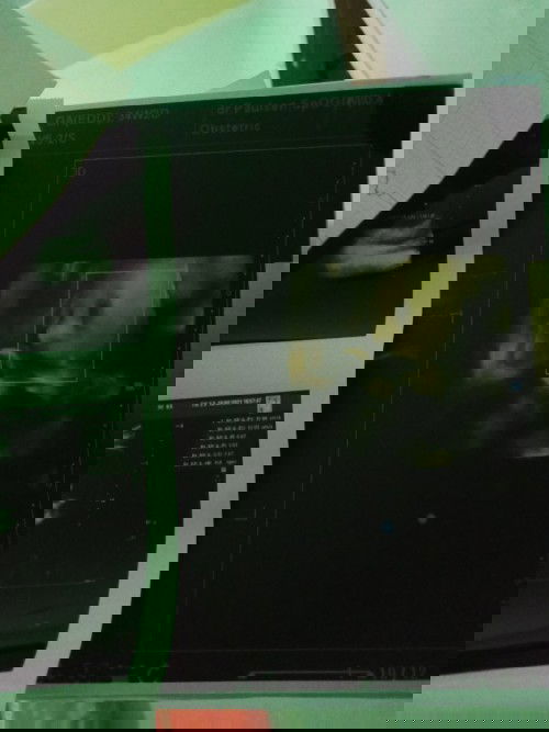 34W3D suntik pematang paru.........