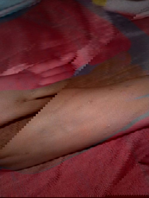 Bintik keras tapi gatal