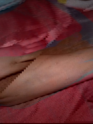 Bintik keras tapi gatal