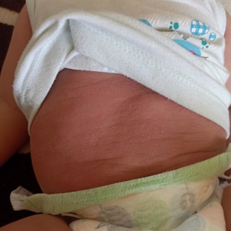 Baby tummy rashes