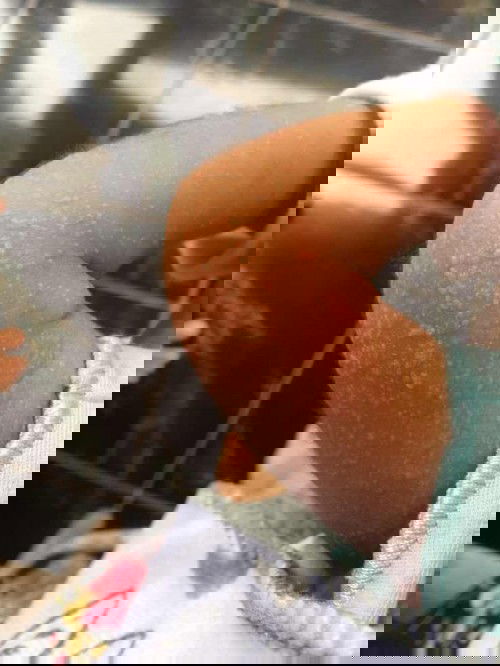 berawal dari beruntus merah ke bruntus putih berair