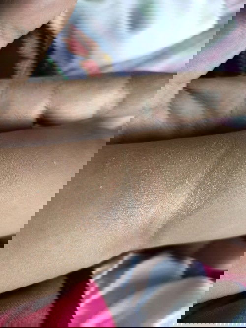 ลูกๆบ้านไหนผิว้ป็นแบบนี้บ้างค่ะ