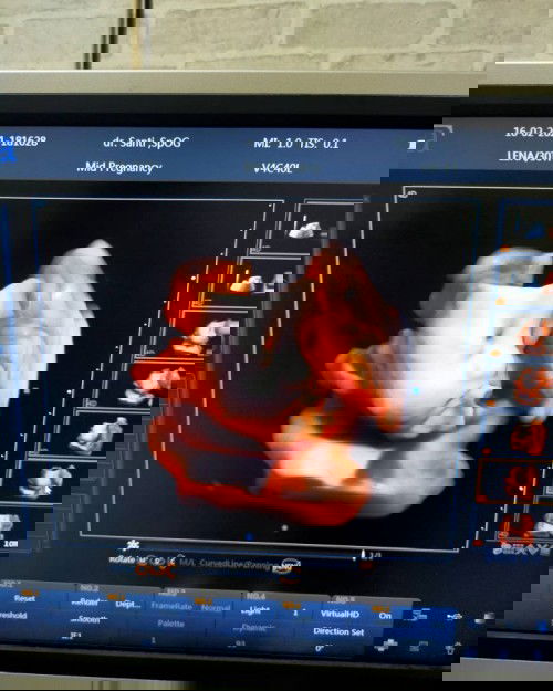 33minggu BBJ masih kurang