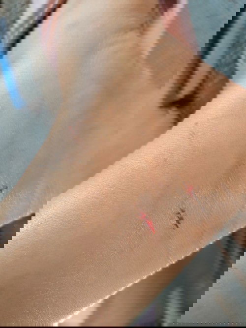 I'm pregnant pero nakagat po ako ng pusa