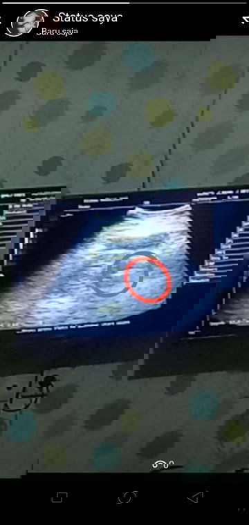 Hasil USG 8w5d blum terlihat