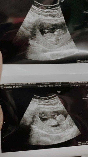 อัลตราซาวด์ไตรมาสแรก