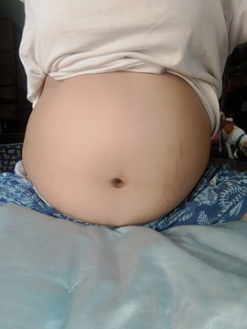 หน้าท้องเเตกแล้ว มีเเม่ๆบ้านไหนเเตกบ้างค่ะ ?