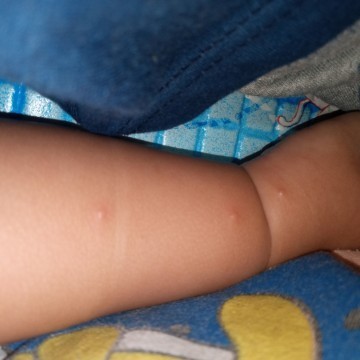 Anak saya umur 5 bln 17 hari..
Mau tnya knpa ad bintik merah begini ya ??