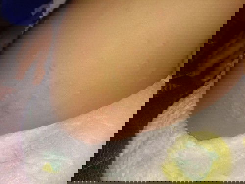 Gatal gatal dengkul dede