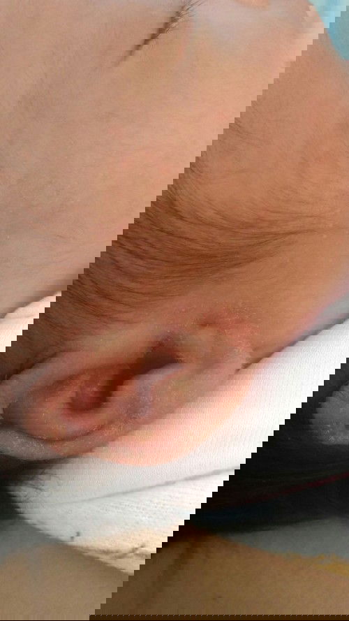 beruntusan dan berair