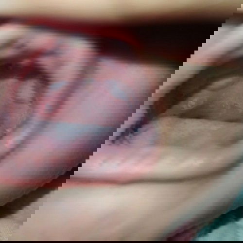 Sariawan anak usia 3 bulan