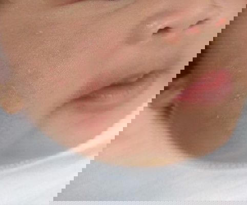 rashes on my baby face?