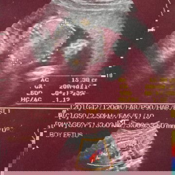 Sure na po ba yan na boy??? Gusto po kc nmin mag asawa☺️ bb girl na dhil meron na kmeng 2 boys☺️