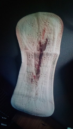 Bleeding, any advice