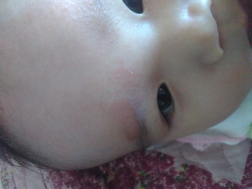 Bé nhà em bị sốt xong bị nổi cái này lên là như nào ạ ?