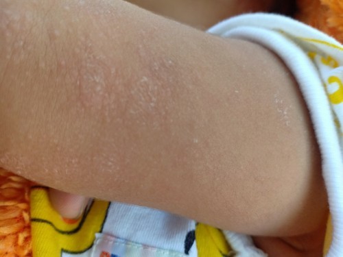 น้องเป็นผื่นขอคำแนะนำหน่อยค่ะ