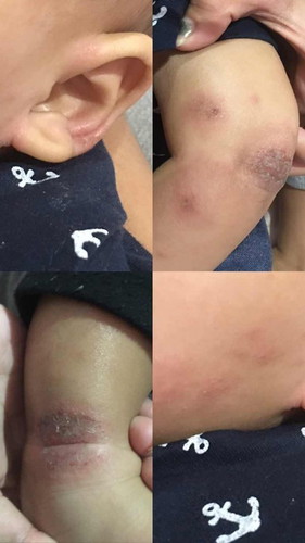 BUN MINTA INFONYA TENTANG EKSIM pada bayi🥺