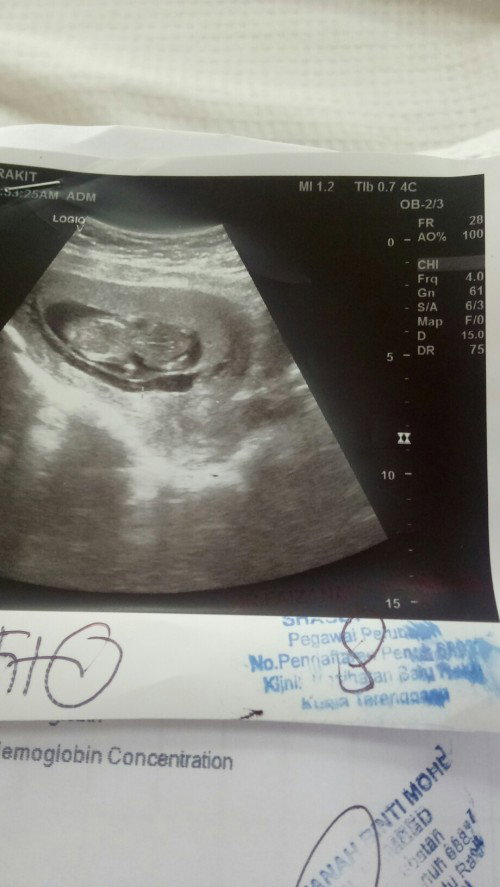 Assalammualaikum..
Saya nak tanya, ada tak mummy2 kat sini pernah mengalami Subchorionic Hematoma