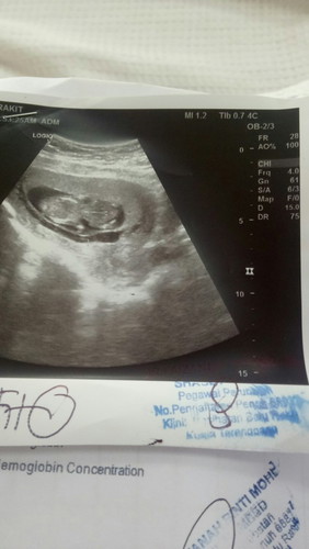 Assalammualaikum..
Saya nak tanya, ada tak mummy2 kat sini pernah mengalami Subchorionic Hematoma