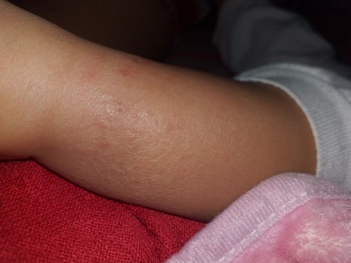 Dry skin ni baby