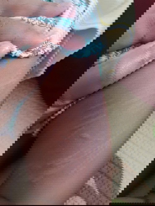 Gatal gatal pada bayi