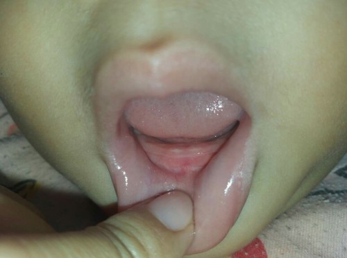 ฟันของลูกจะขึ้นใช่มั้ยคะ