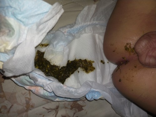 Amoeba sa Poop ni baby