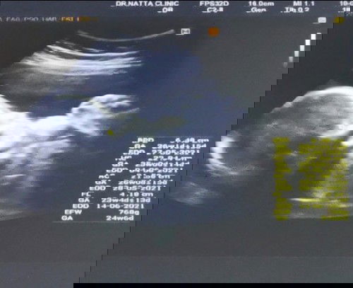 ท้อง24 สัปดาห์ค่ะ น้องหนัก 768 ก. ลูก ๆ ของคุณแม่ตอน 6 เดือน หนักเท่าไหร่​คะ กลัวลูกหนักเกินค่ะ^^;