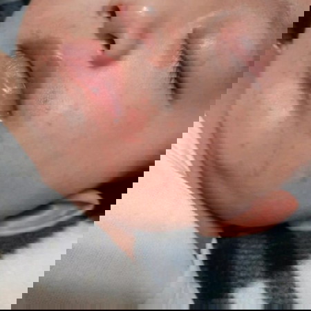 4 months 17days old baby/ Rashes