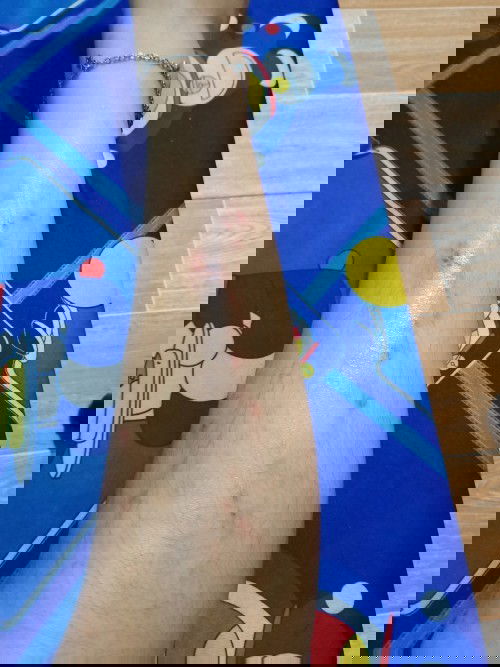 Có mom nào bầu mà chân bi ngứa như em không mom nào biết sức gì chỉ em với