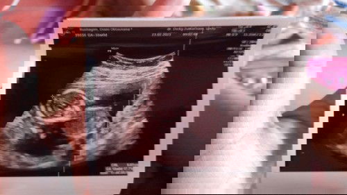 Panjang janin tidak sesuai usia janin