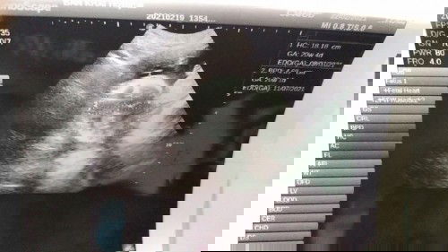 คือซาวน์แล้วหมอบอกหัวเด็กใหญ่แต่น้ำคร่ำน้อยต้องหาหมอเฉพาะทาง​ อยสกทราบว่าในภาพเด็กปกติมั้ยค่ะ